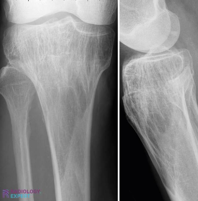 Paget Disease of the Bone