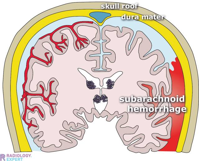 CT brain hemorrhage