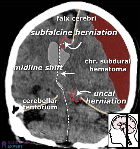 subfalcine herniation