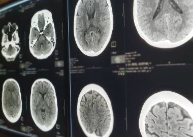 CT brain hemorrhage