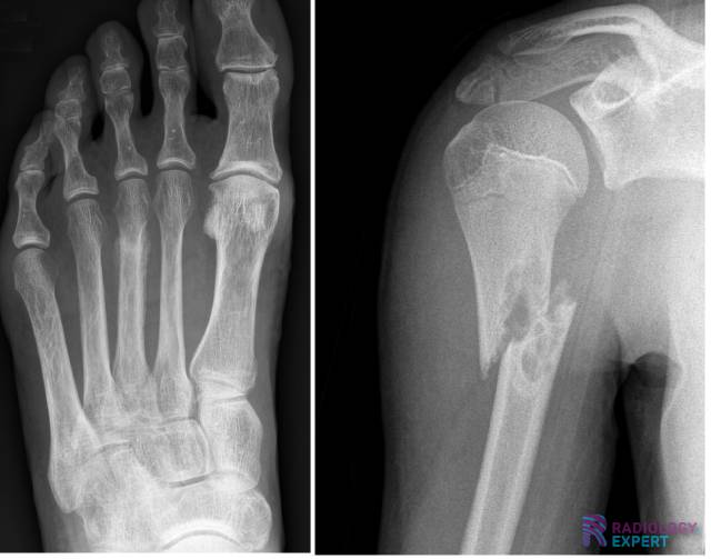 stress fracture and pathological fracture
