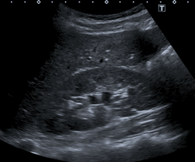 healthy kidney ultrasound