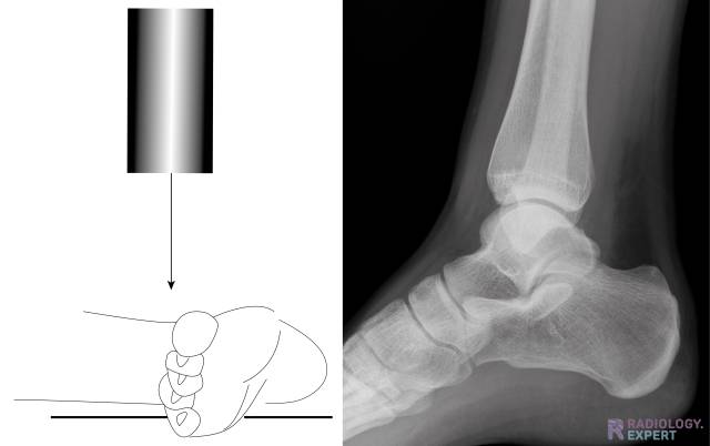 Systematic Way to Read Foot Xrays - Ortho Conditioning