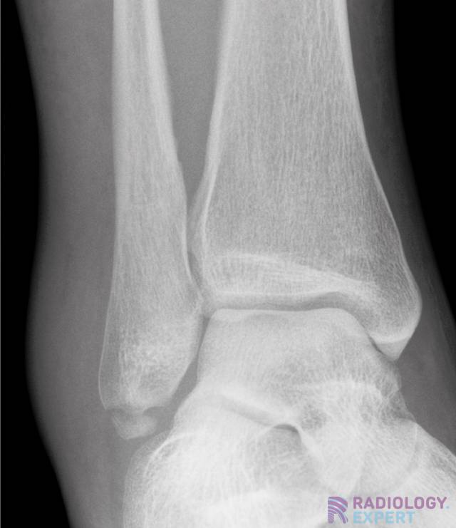 normal ankle xray ap