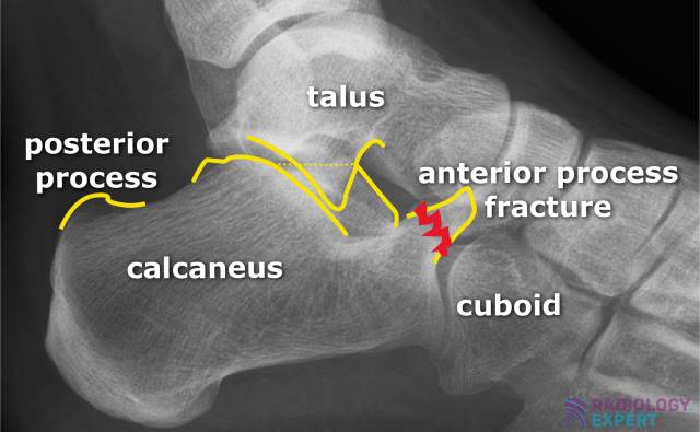 anterior calcaneus fracture