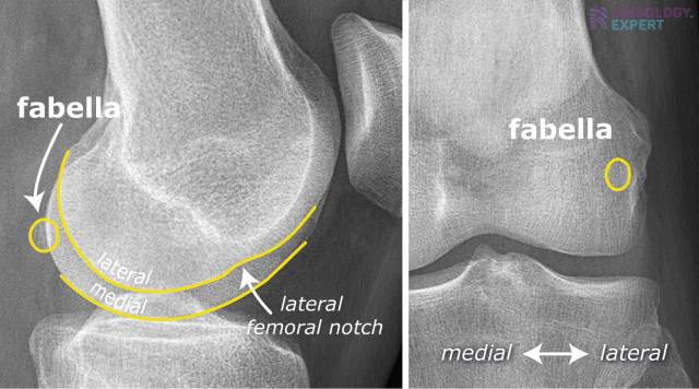 lateral femoral condyle