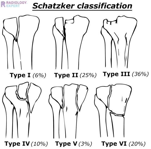 patella fracture classification