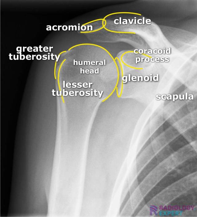 xray shoulder dislocation