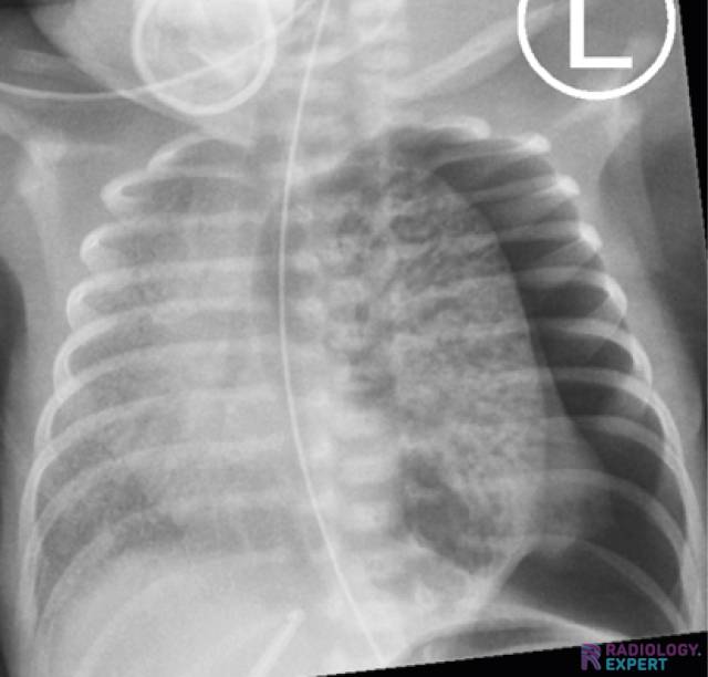infant pneumothorax x ray