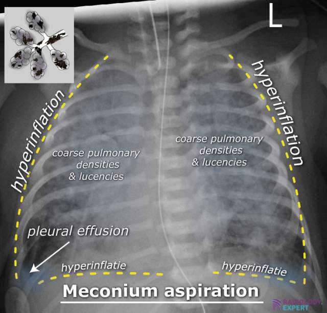 hyperinflation chest x ray