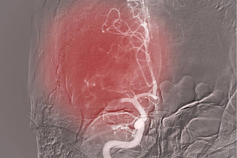                              <strong>Interventional Radiology</strong>
                        